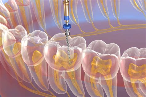 endo pizzeria|Endodontic Treatment .